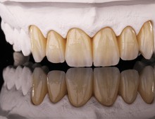 Ceramic Restorations