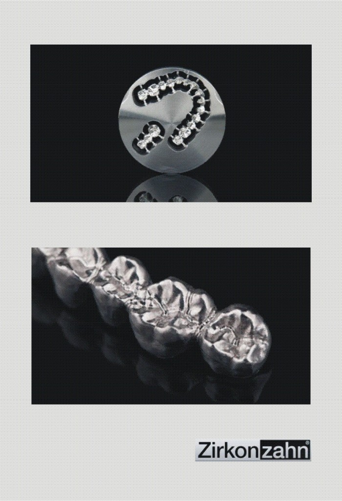 Creative Smile Dental Laboratory Ltd » Metal Restorations